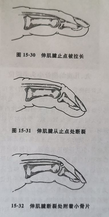 肌腱起点的三种损伤导致锤状指,伸肌腱止点处被拉长,但没有被拉断.