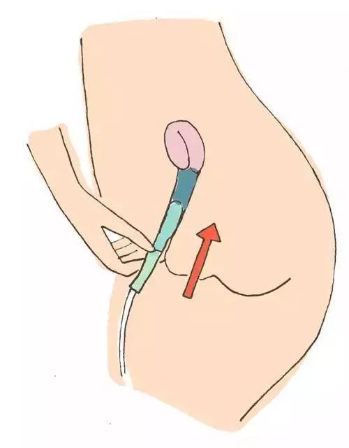 在卫生巾之前,女性都用过什么鬼东西来处理"大姨妈"?