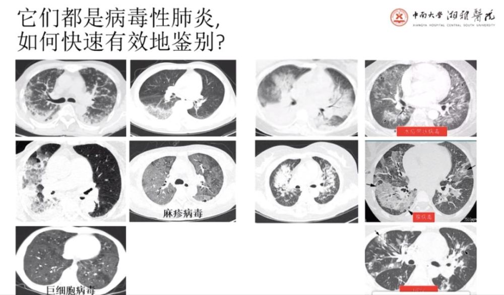 4 次核酸阴性后 ct 确诊,新冠肺炎 ct 表现 5 个特点请牢记