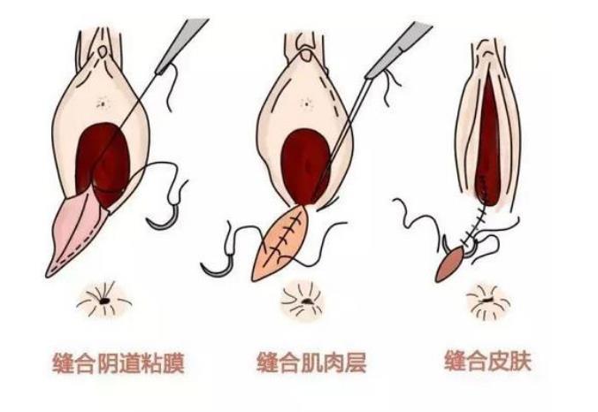 比起严重的撕裂,医生如果能及时做会阴切开术,侧切的伤口整齐,清洁