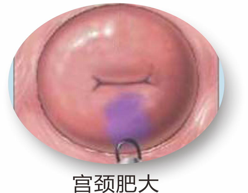 宫颈肥大是怎么回事?