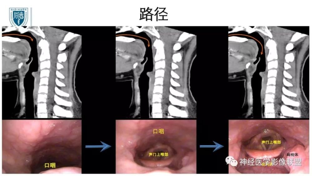 内窥镜对照的咽喉部ct解剖