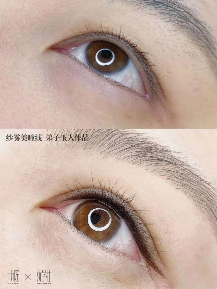 美瞳线如何做到零结痂?