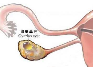 什么是卵巢囊肿?