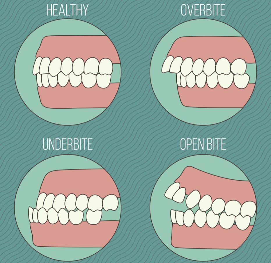 人的牙齿咬合结构包含上颌骨和下颌骨, 但是并不是所有人天生上下颌骨