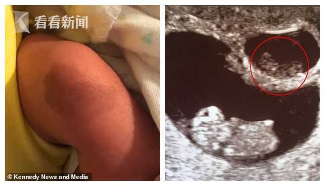 胎死腹中却将b超影像留在双胞胎弟弟腿上 妈妈:姐姐被弟弟吸收了