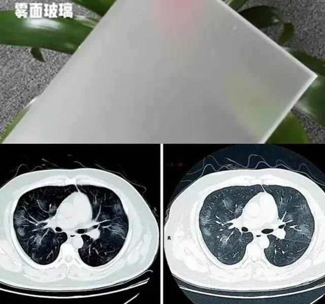 不同类型的新型冠状病毒肺炎,影像学表现不同