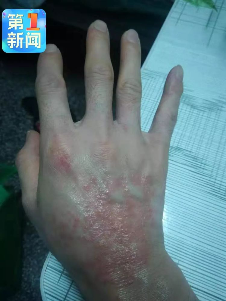 厚厚的橡胶手套下 是湿疹或过敏的手,是大片的皴裂