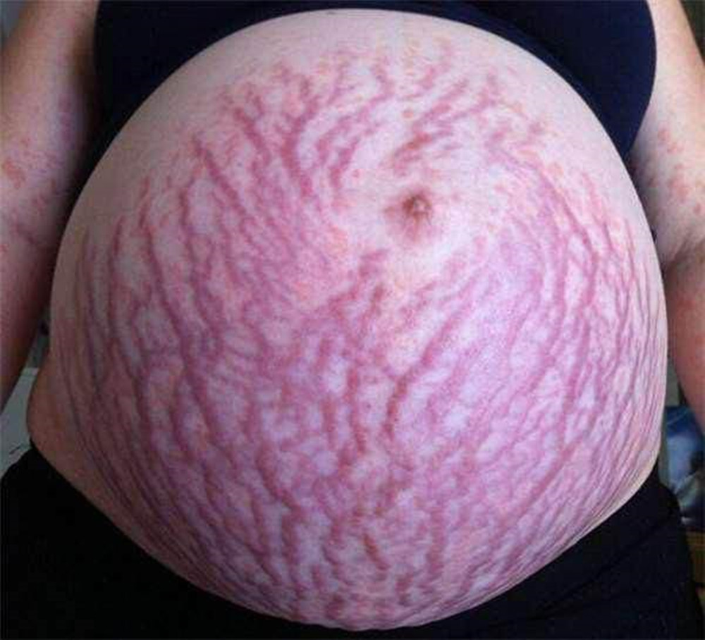 孕晚期,怀孕,妊娠纹