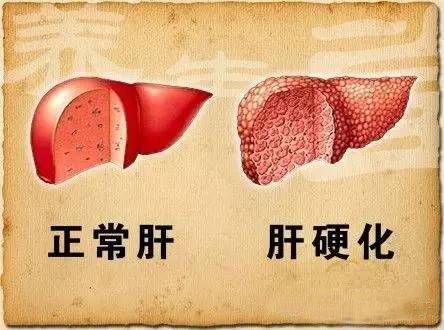 肝硬化是"哑巴病",一发现就是晚期?5个信号是早期萌芽