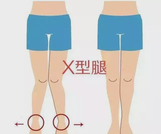 倩狐:腿型不好看怎么办?这里有份矫正合集来接好了!