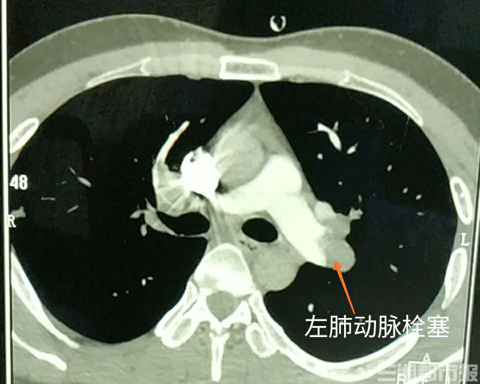 33岁男子久宅不动竟致"肺栓塞" 专家提醒:在家要科学"