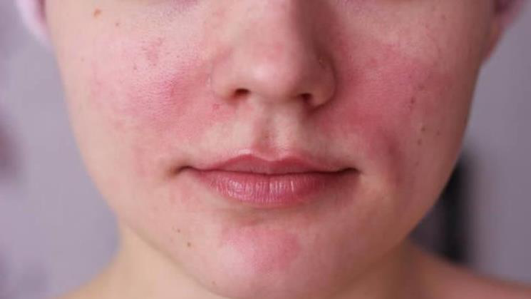 鼻翼两侧总是发红,是什么皮肤病?