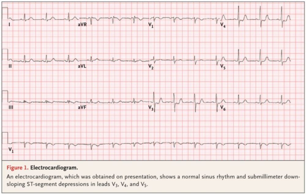 胸痛,冠脉,主动脉夹层,心电图,心肌缺血
