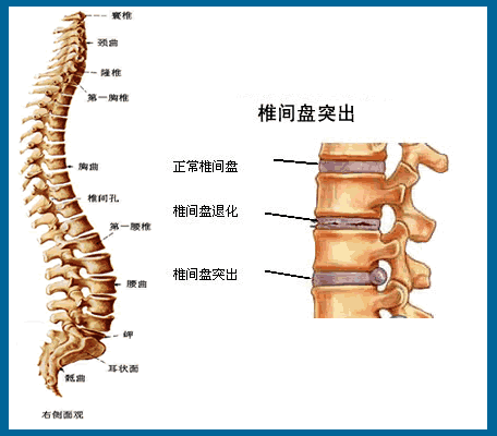 腰椎间盘突出症脊柱侧凸是怎么回事