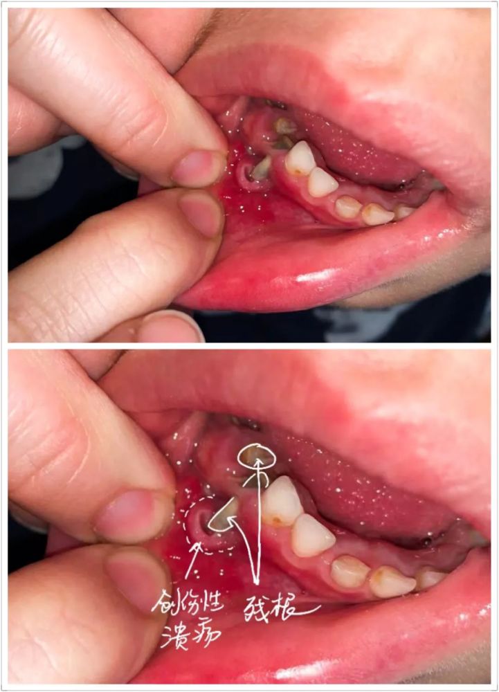 口腔,牙齿,乳牙,口腔溃疡,口腔科