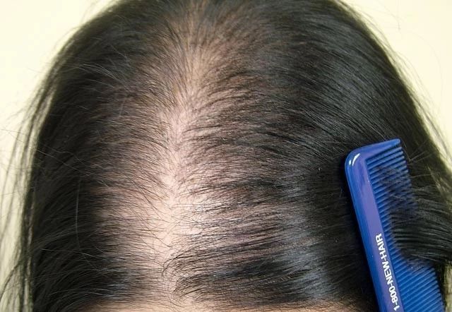 大部分严重的女性脱发基本上都是女性型脱发(fphl),呈现出 弥散性