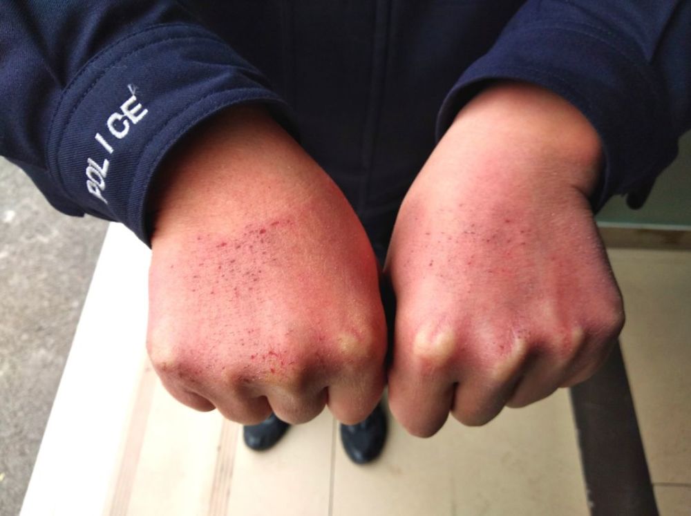 长时间戴防护手套导致过敏,31岁的熊川双手手背皮肤裂开血口 眼前的