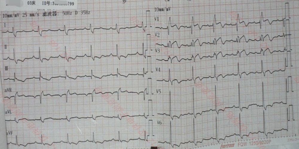 高危心电图只知道 st 抬高?这 10 种情况不可忽略