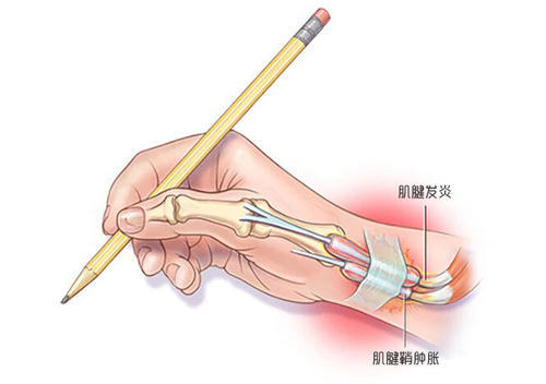 手腕肌腱炎治疗方法 手腕腱鞘炎最好的治疗方法