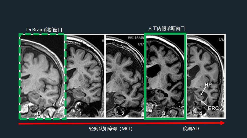 脑健康,核磁,脑萎缩,痴呆,核磁共振