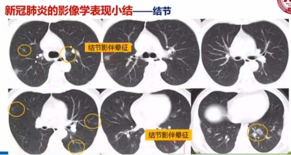 新冠肺炎影像学的13种特点,这篇文章为你总结全了!