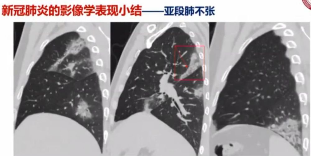 新冠肺炎影像学的13种特点,这篇文章为你总结全了!