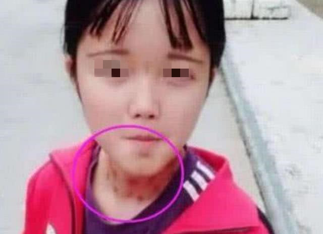 12岁女孩脖子有"草莓印",爸爸逼问下,女儿说"是你造成