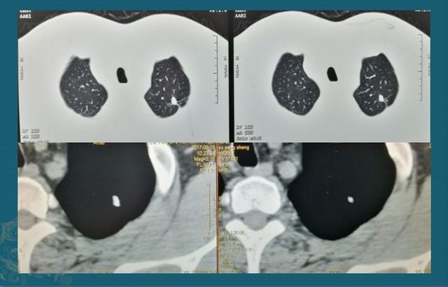 肺结核与肺癌像"真假美猴王",医生教你用ct片当照妖镜