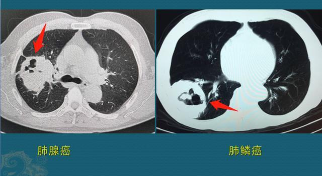 (二)肺结核与肺癌的周围变化