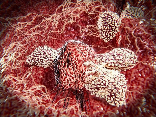 癌细胞是怎么来的?基因突变