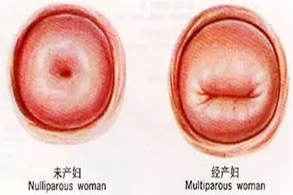 没有打过胎或者是没有生育过的宫颈是呈圆形的,而做过人流手术的宫颈