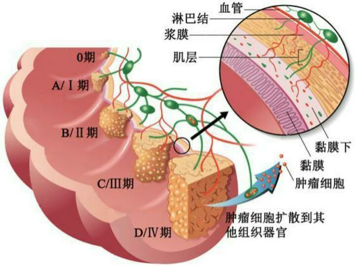 直肠癌,淋巴结,淋巴,肿瘤,癌细胞,直肠
