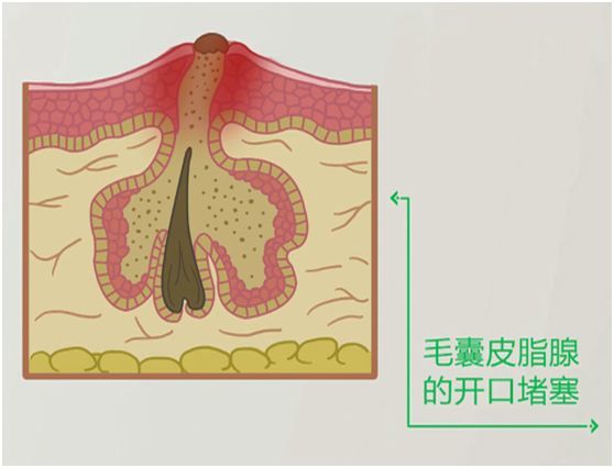 病毒,痤疮,口罩,痤疮丙酸杆菌,皮脂腺