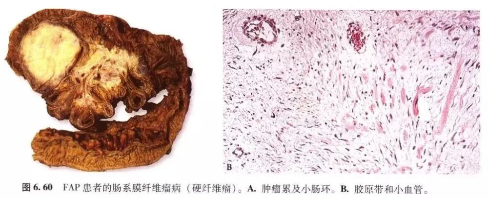 家族性腺瘤性息肉病