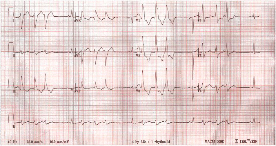 心肌病,室性早搏,心脏,心电图,心力衰竭