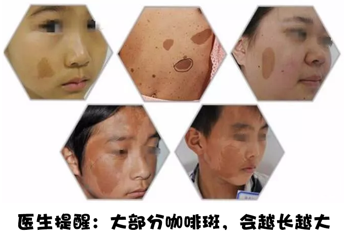 为什么咖啡斑越早诊治越好?