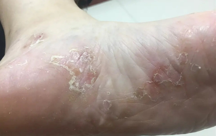 脚气在医学上叫做"足癣",是"真菌"感染导致的一种足部的传染性皮肤病