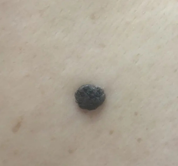 她指着身上一块黑斑,问我:"医生,我身上这块是什么斑啊?