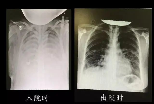 医生用了一种手段,白肺很快变黑