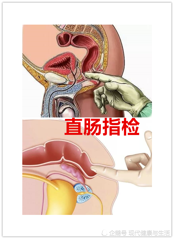 如何早期去发现直肠癌的先兆表现