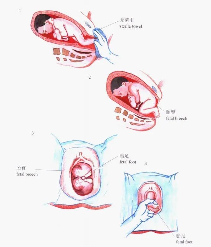 图解妇产科小手术23:产妇臀位牵引手术