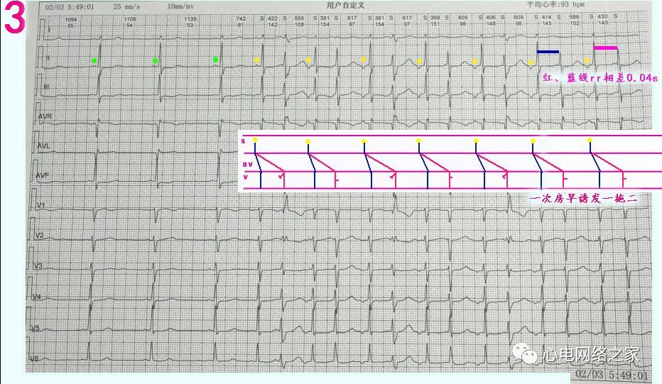 心电图实例解图系列174-室早或结早伴间歇性三相束支阻滞,疑一拖二dav