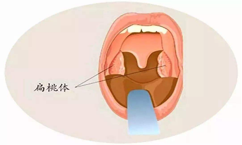 小孩子感冒引起扁桃体炎,为什么扁桃体发炎有喉咙被堵住的感觉?