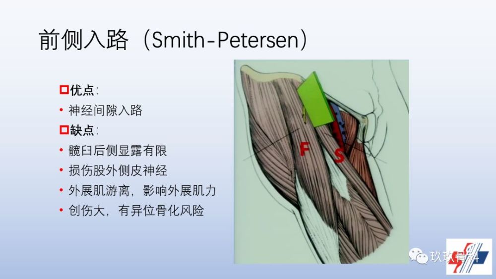 髋关节置换手术入路选择困惑