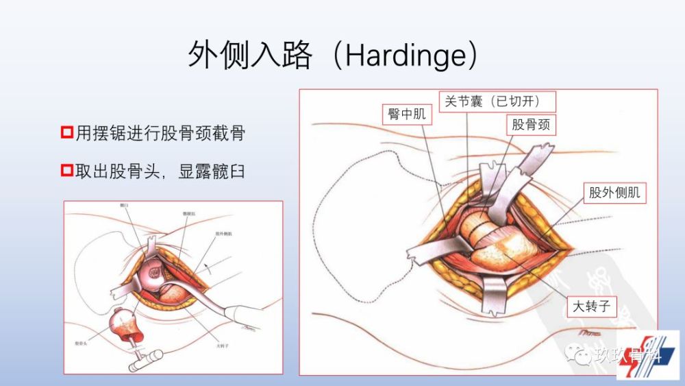 髋关节置换手术入路选择困惑