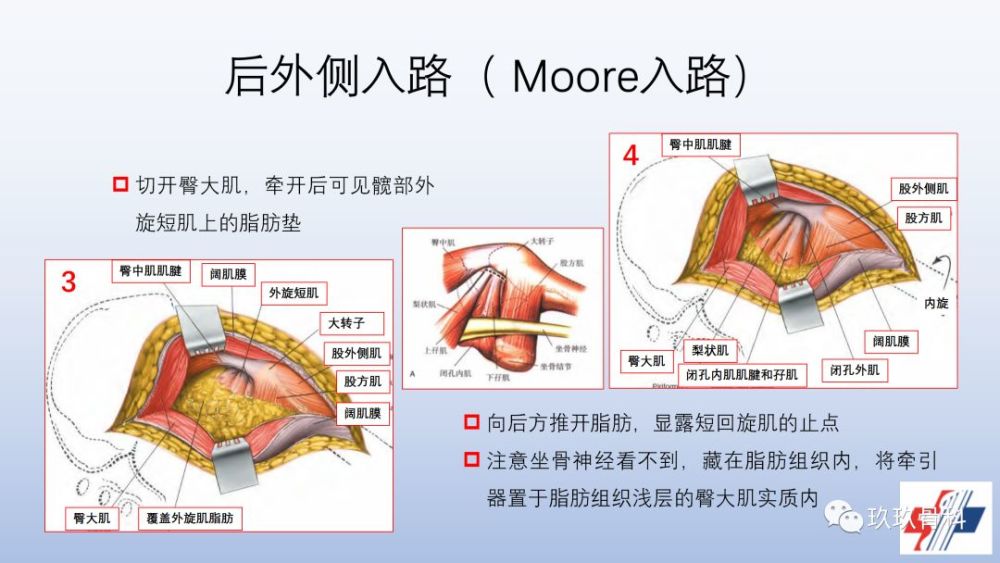 髋关节置换手术入路选择困惑