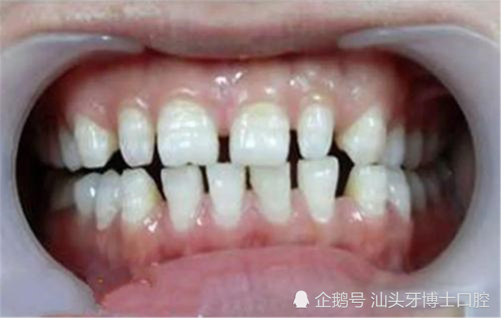 宝宝牙缝大,乳牙牙缝大,乳牙换牙,多生牙,阻生牙