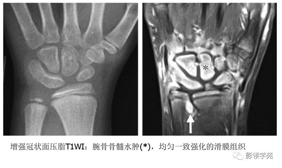 幼年特发性关节炎影像学表现