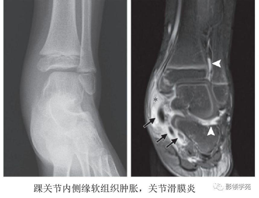 幼年特发性关节炎影像学表现